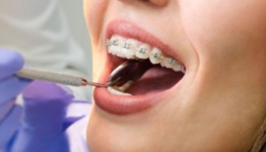 Diş Teli Uygulamaları