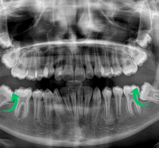 What is Orthodontic Mini Screw Application?