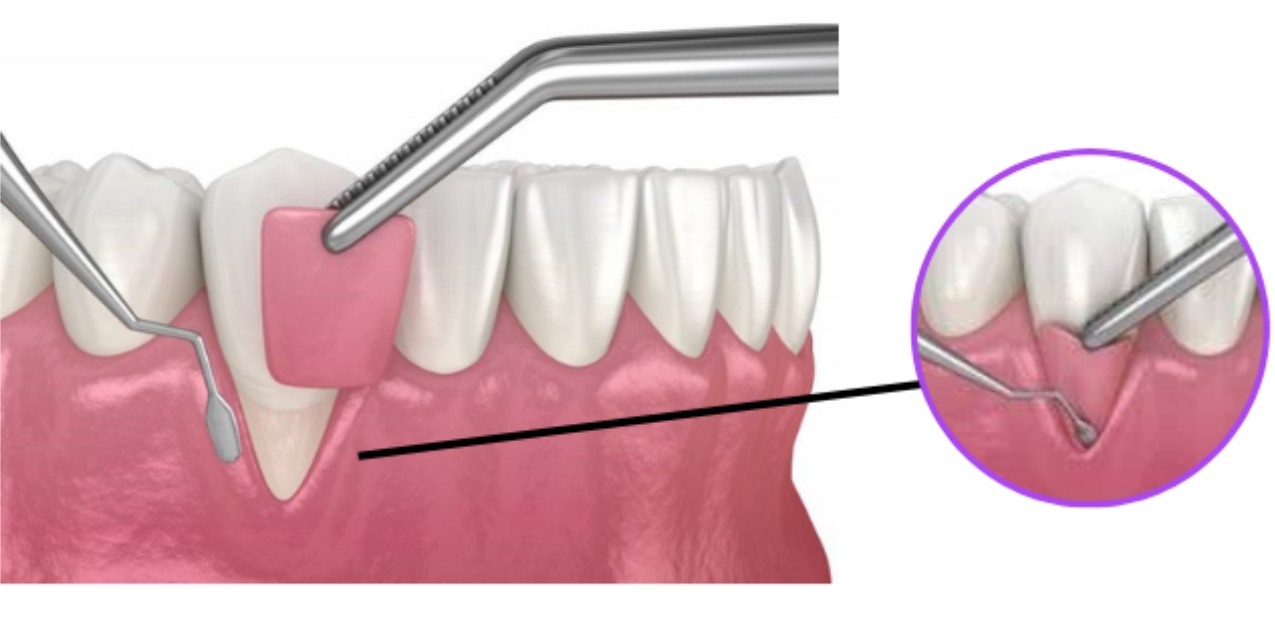 What is Free Gingival Graft Application?