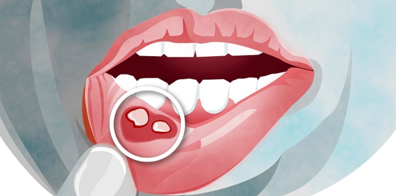 Do Not Neglect Chronic And Non-Healing Mouth Wounds